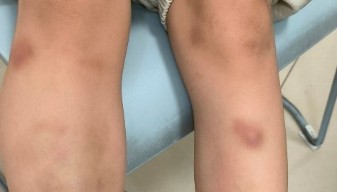 深圳6岁男童吃生菜包烤肉后，全身出现大片青斑、血肿